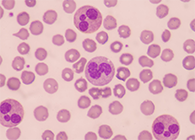 一种神秘颗粒被发明了！它能否成为败血症早筛标记物？？？？？？？